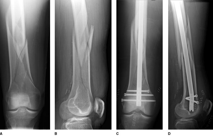 Osteosarcoma Institute Grant Program for Research Innovation